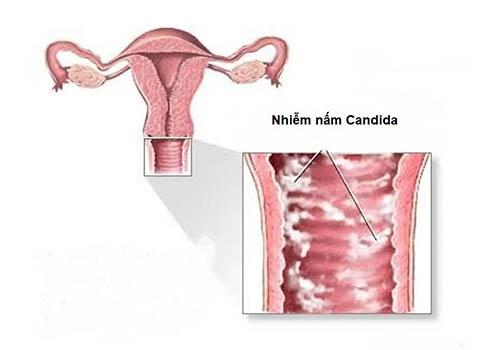 nhiem-nam-candida.jpg