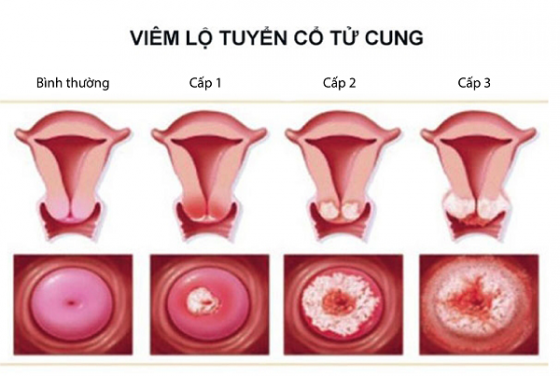 chi-phi-chua-viem-lo-tuyen-co-tu-cung-3.png
